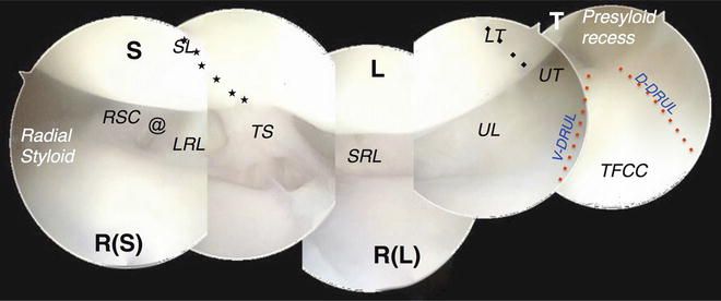 View inside the radiocarpal joint of the wrist through the arthroscope