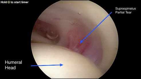 Partial-thickness rotator cuff tear