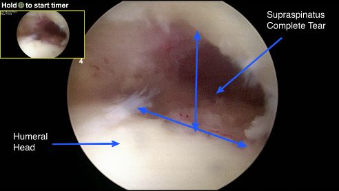 Arthroscopic view of a full-thickness supraspinatus rotator cuff tear