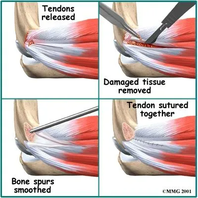 Elbow after tennis elbow surgery