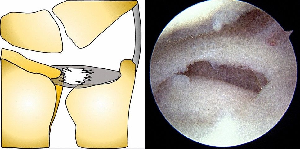 Illustration of a TFCC tear on the little-finger side of the wrist
