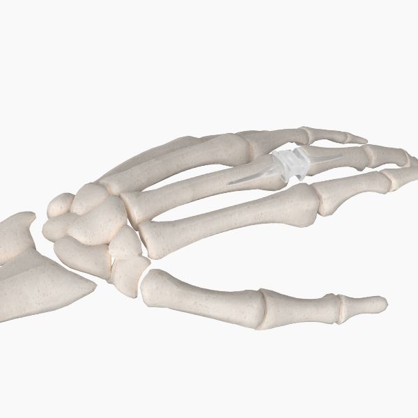 Silicone PIP joint replacement
