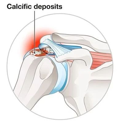 Overview of calcific tendonitis in the shoulder