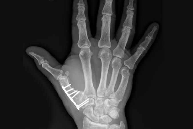 X-ray of a thumb CMC joint fusion