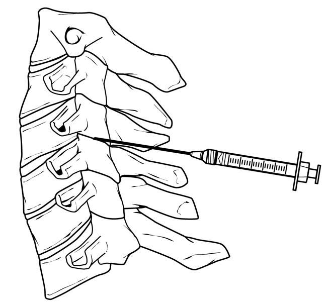 Image-guided nerve root injection in the neck