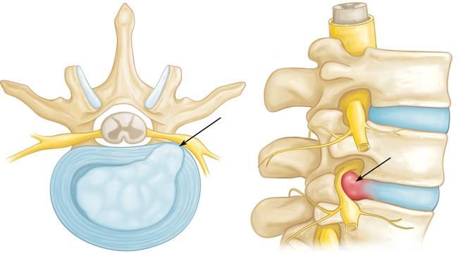 Herniated disc pressing on a nerve root in the neck