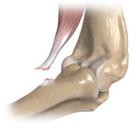 Distal biceps tendon rupture at the elbow