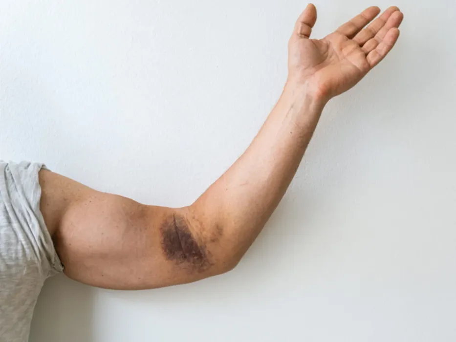 Bruising on the forearm after a distal biceps rupture