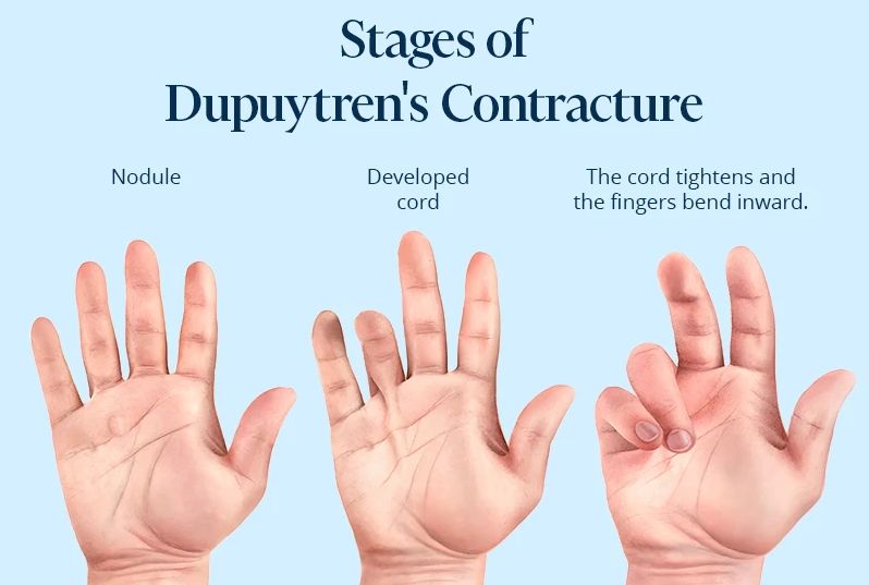 The stages of Dupuytren's disease