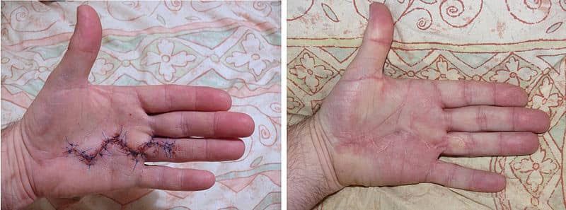 Scarring after Dupuytren's surgery
