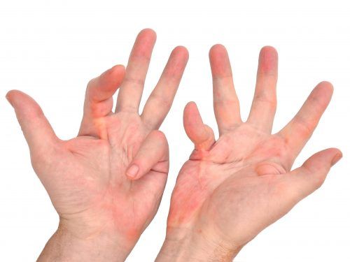 Dupuytren's disease in both hands