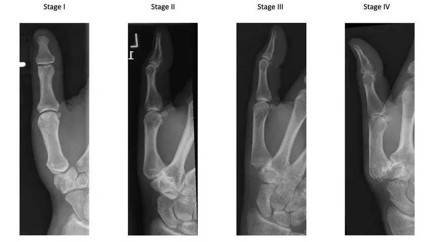 Eaton-Littler stages of thumb base (CMC) arthritis on X-ray