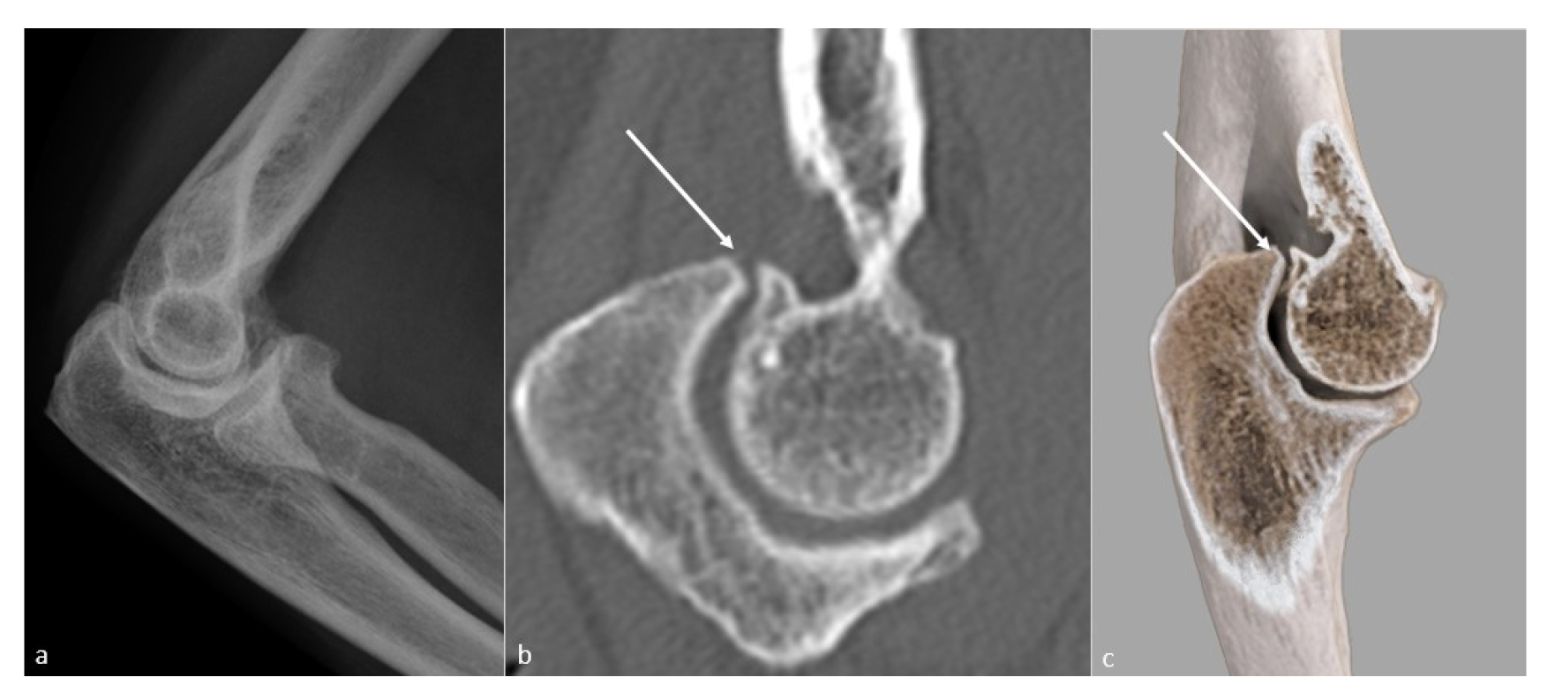 Elbow arthritis imaging