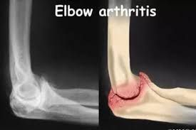 Elbow arthritis