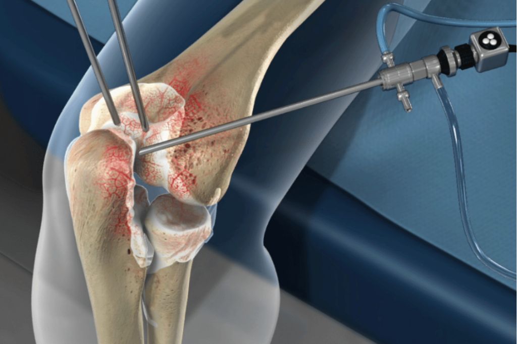 Elbow arthroscopy