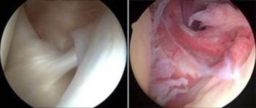 Arthroscopic view of frozen shoulder