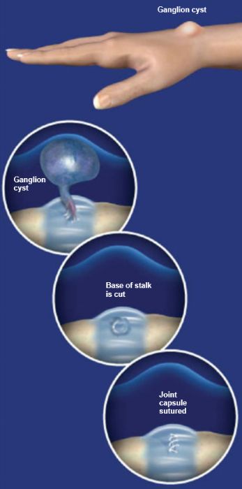 How a ganglion forms from a joint or tendon sheath