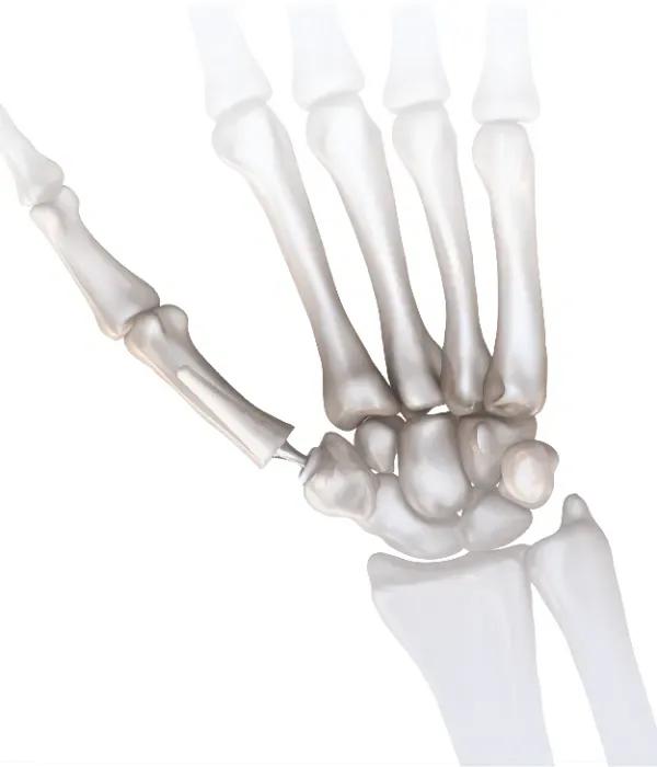 Illustration of the thumb base (CMC) joint
