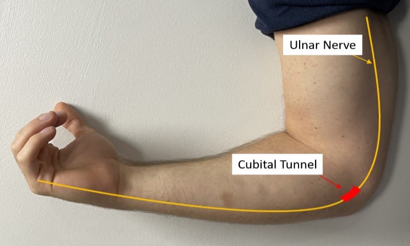 Course of the ulnar nerve from the neck, behind the inner elbow and into the hand