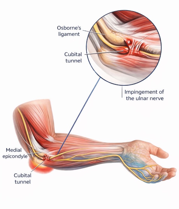 Illustration of cubital tunnel syndrome at the inner elbow
