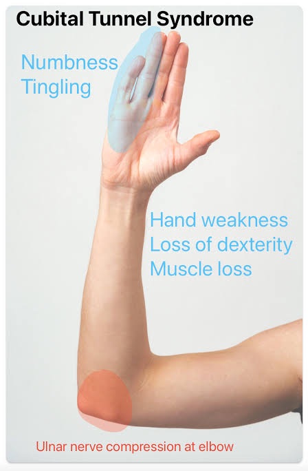 Area of the hand supplied by the ulnar nerve: the little finger and half of the ring finger