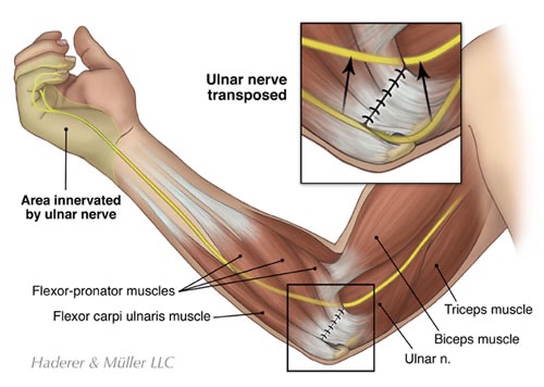 Ulnar nerve moved to the front of the elbow during an anterior transposition