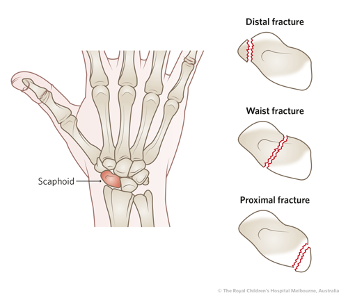 Types of scaphoid fracture by location: distal pole, waist and proximal pole