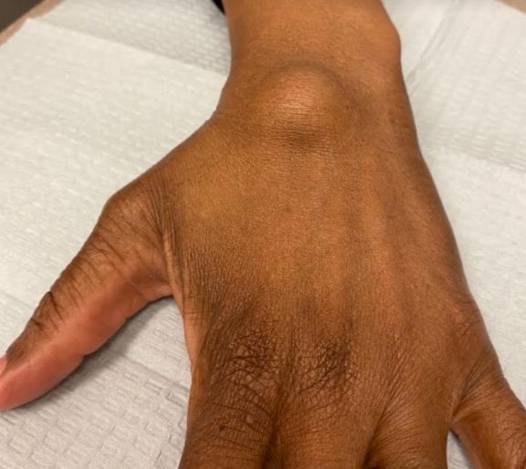 Dorsal wrist ganglion on the back of the wrist
