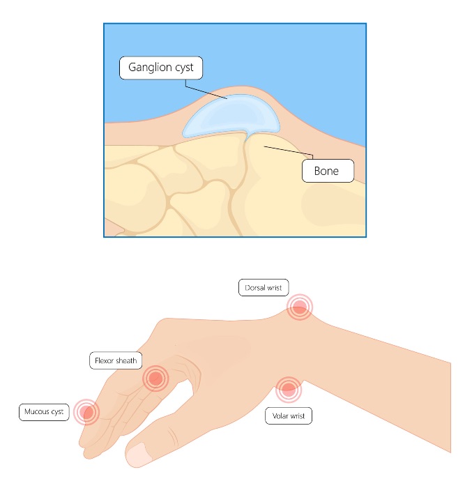 Common sites of ganglions around the hand and wrist