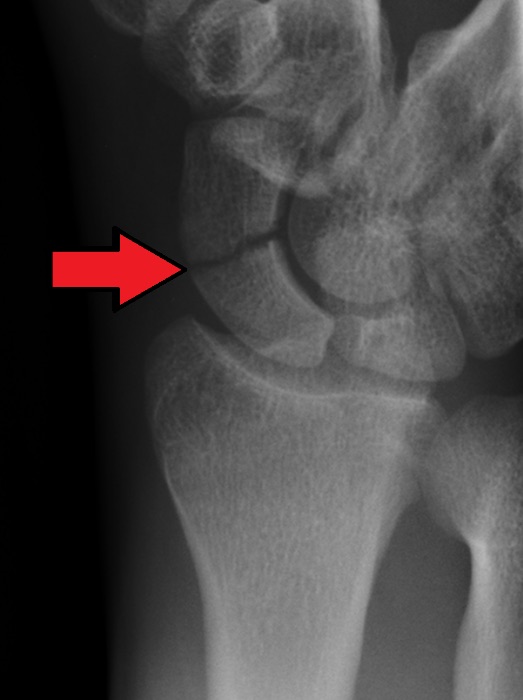 X-ray of a scaphoid fracture