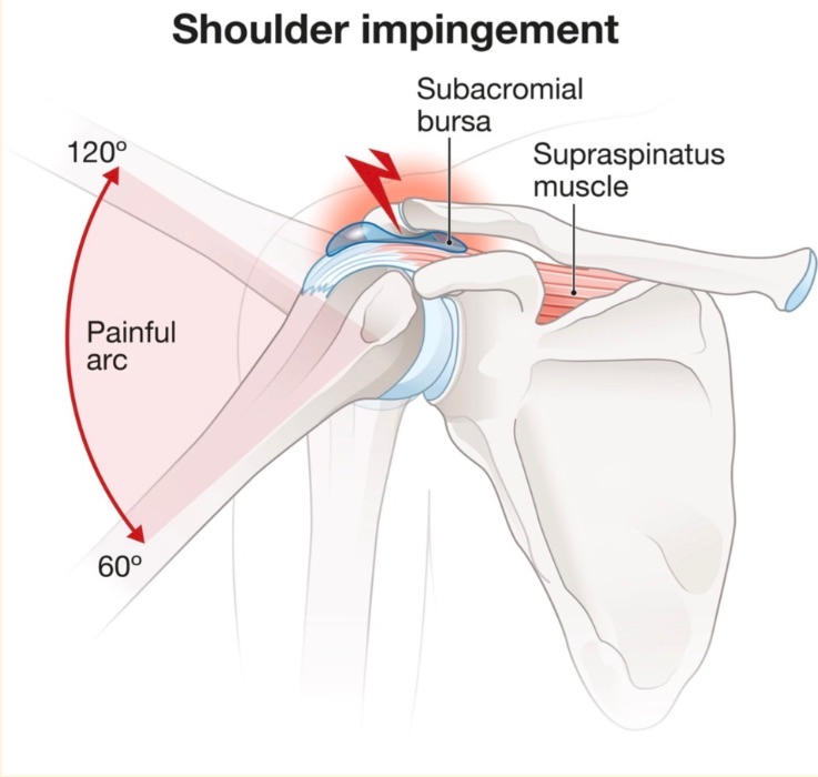Shoulder impingement