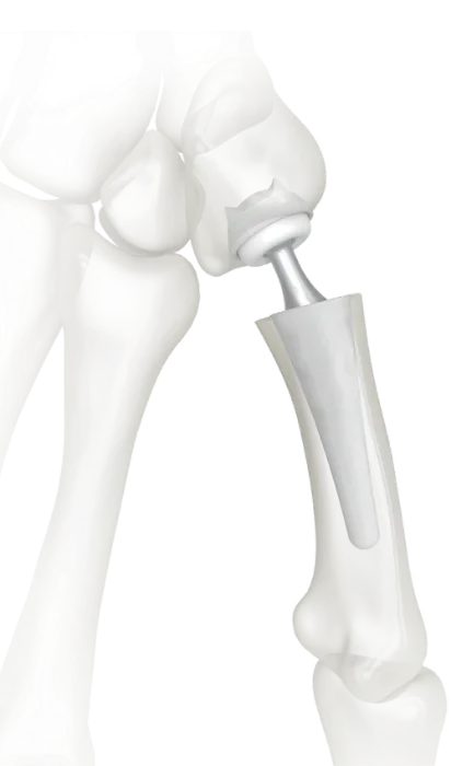 Thumb CMC joint replacement implant