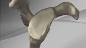 Image showing glenoid bone loss in the shoulder socket