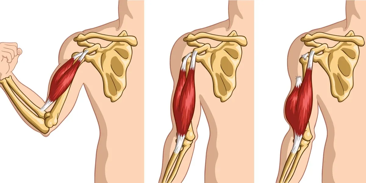 Long head of biceps rupture showing the Popeye sign in the upper arm