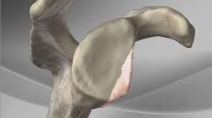 Scan showing bone loss from the front of the glenoid after shoulder instability