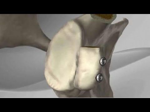 Diagram of the Latarjet procedure with the coracoid bone fixed to the front of the socket with screws
