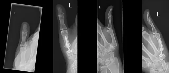 X-ray of a thumb CMC joint replacement