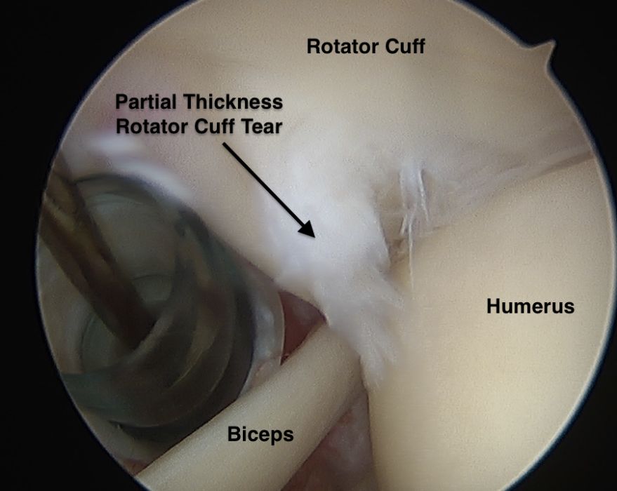 Partial-thickness rotator cuff tear showing tear depth