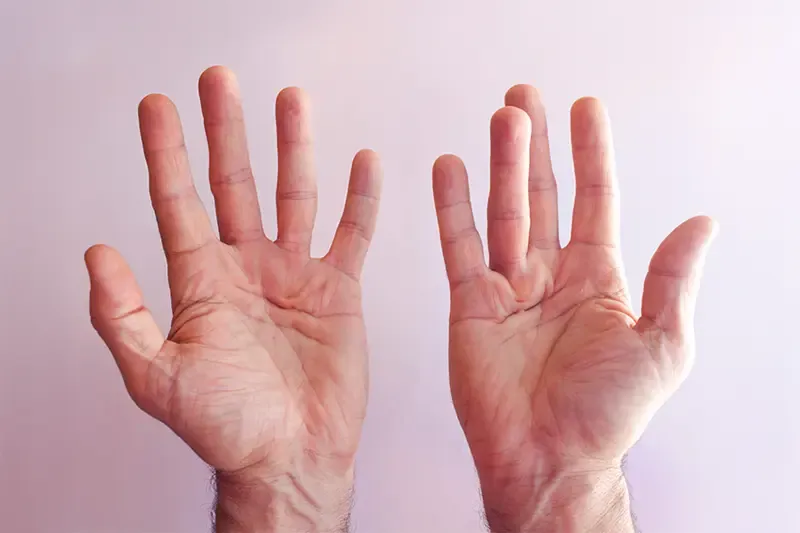 Dupuytren's contracture affecting both hands