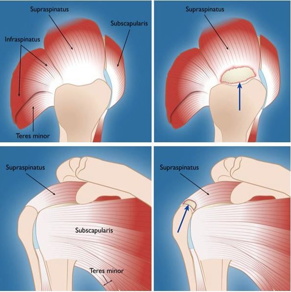 Illustration of a torn rotator cuff tendon in the shoulder