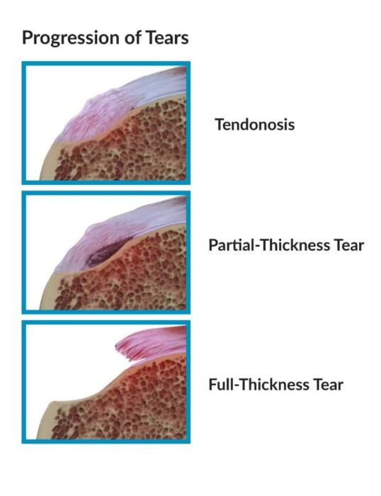 Illustration of the rotator cuff tendons and tendinosis