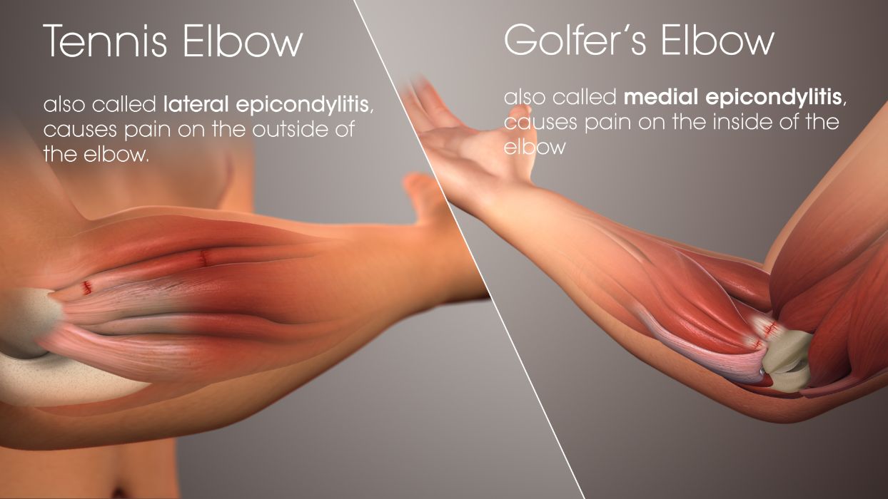 Tennis elbow on the outer side of the elbow compared with golfer's elbow on the inner side