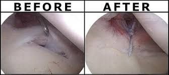 Arthroscopic view of a SLAP tear being repaired