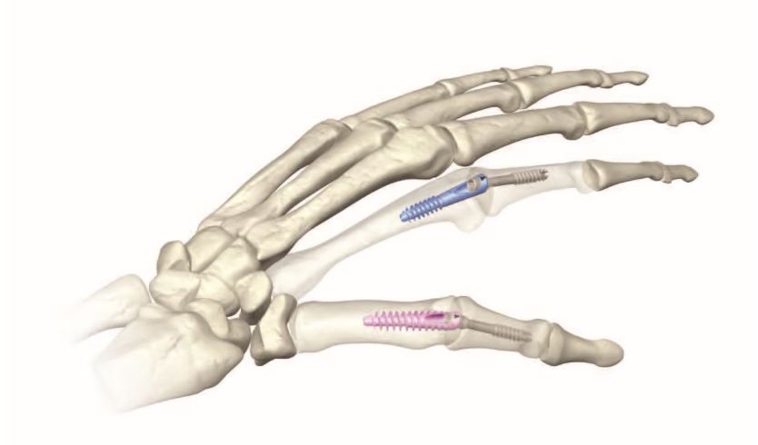 X-ray of an MCP knuckle joint fusion