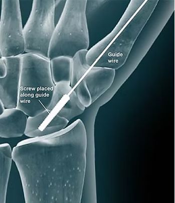 Scaphoid screw passed over the wire