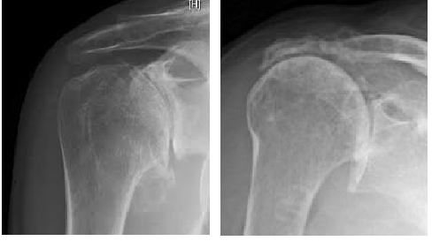 X-ray of a shoulder with arthritis