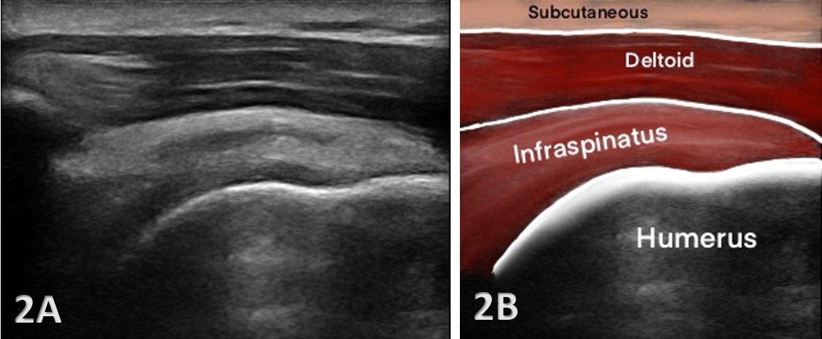 Ultrasound images of the shoulder tendons