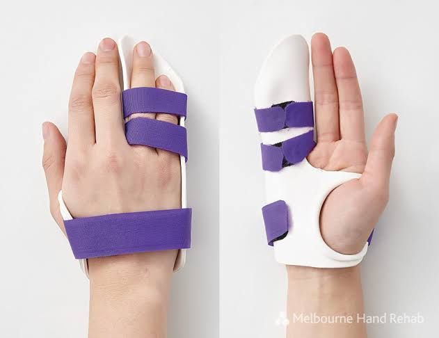 Splint worn after Dupuytren's surgery