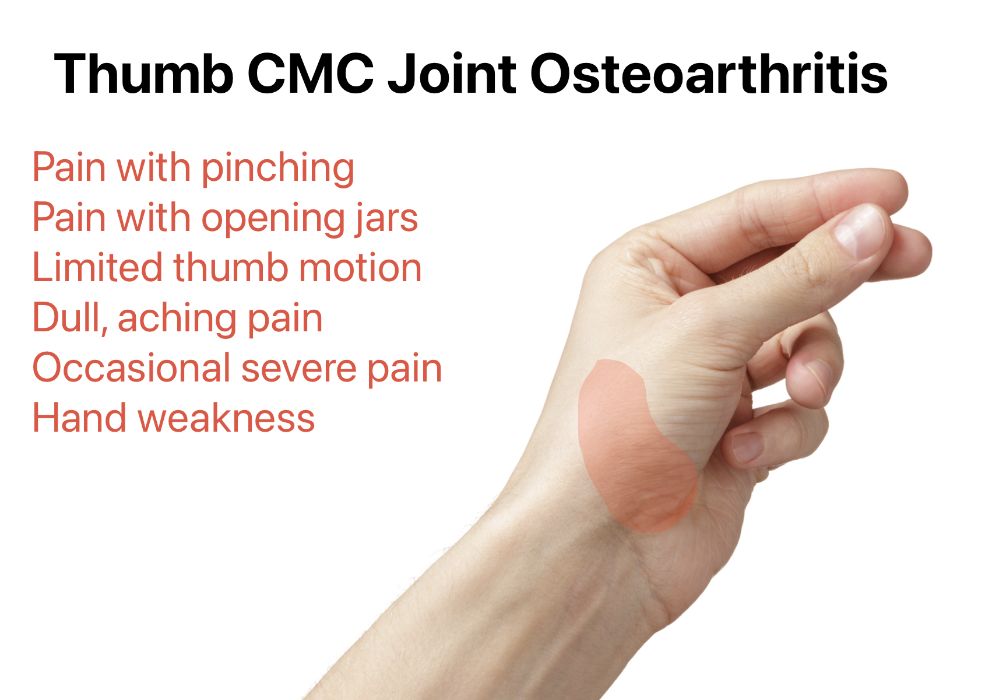 Symptoms of arthritis at the base of the thumb (CMC joint)