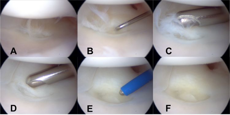 Arthroscopic view of TFCC resection in the wrist